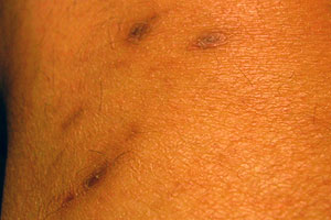 graphic image of dog bite